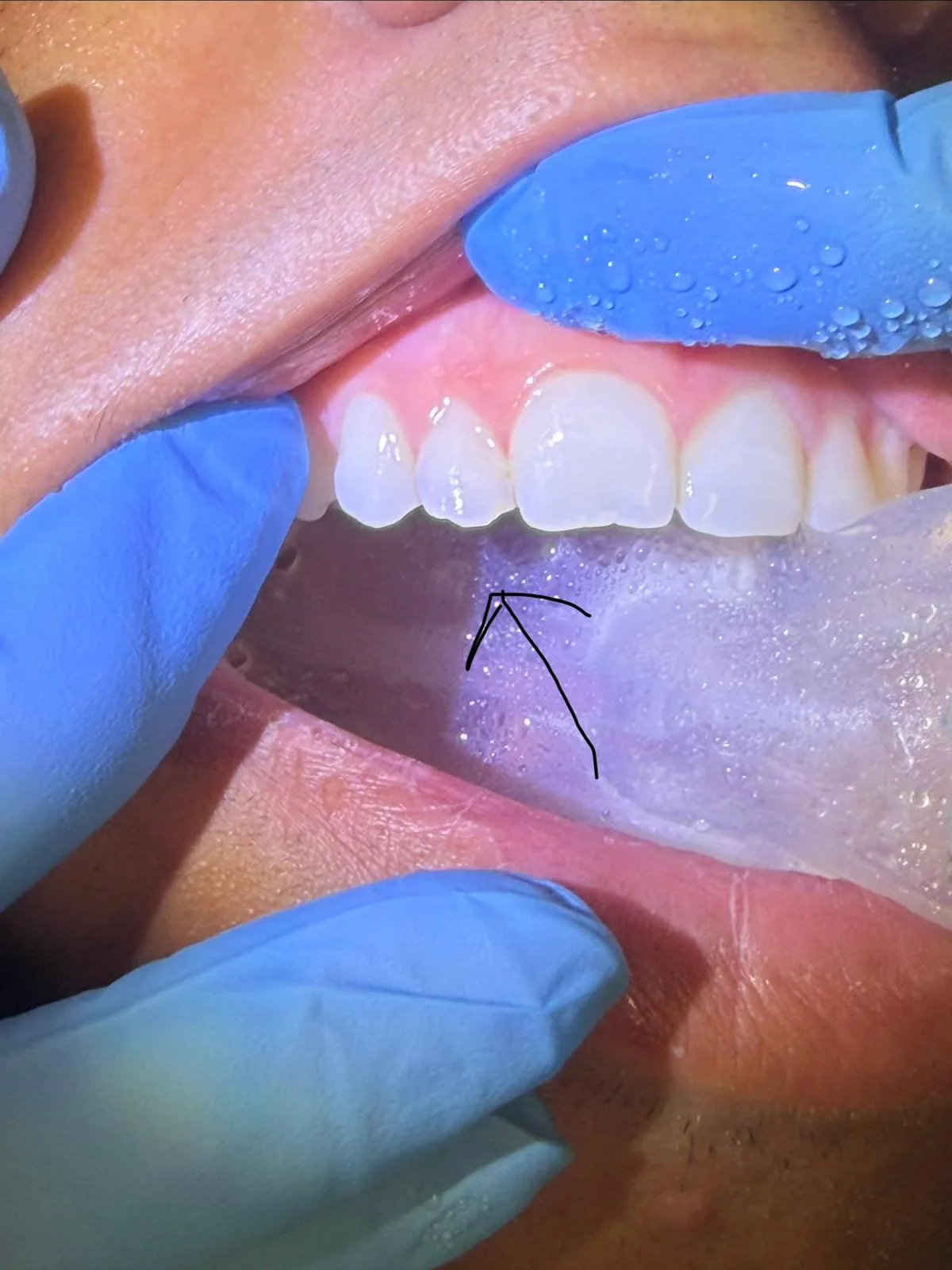 Close up of a child's smile following dental bonding of the front teeth