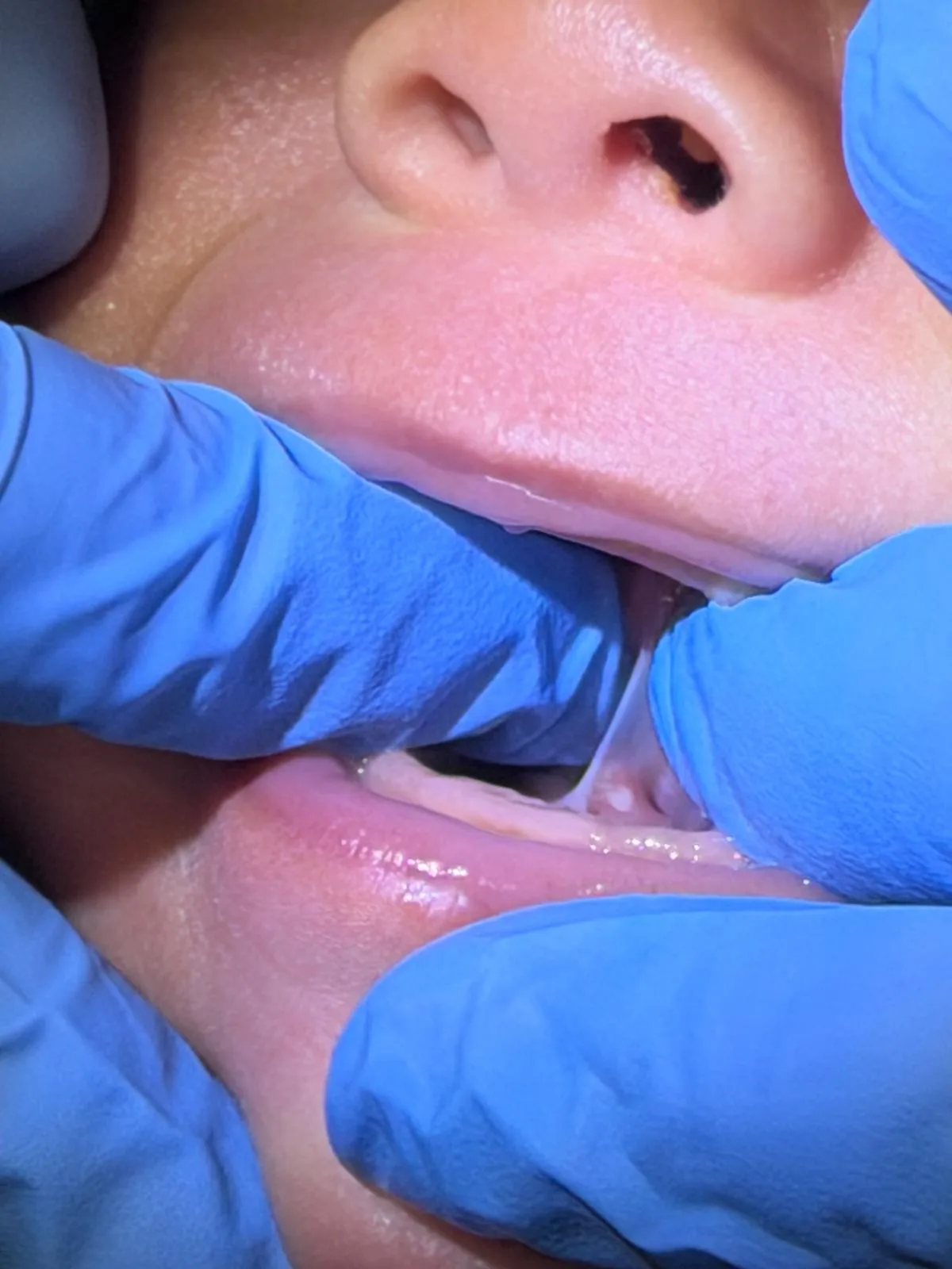 Restricted labial frenum in an infant before laser frenectomy