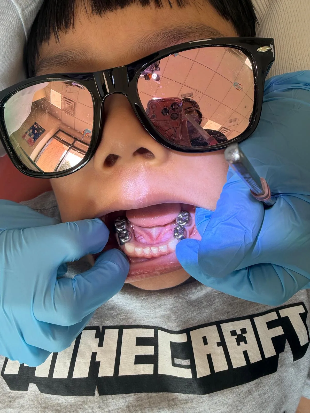 Stainless steel crowns restoring a child's back molars