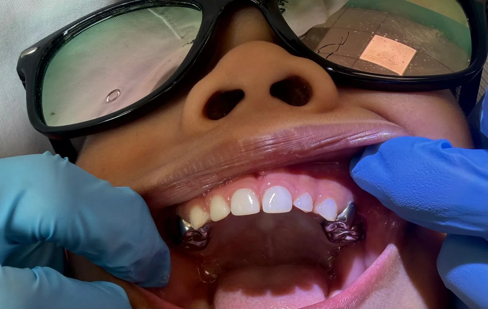 White crowns restoring a child's front teeth