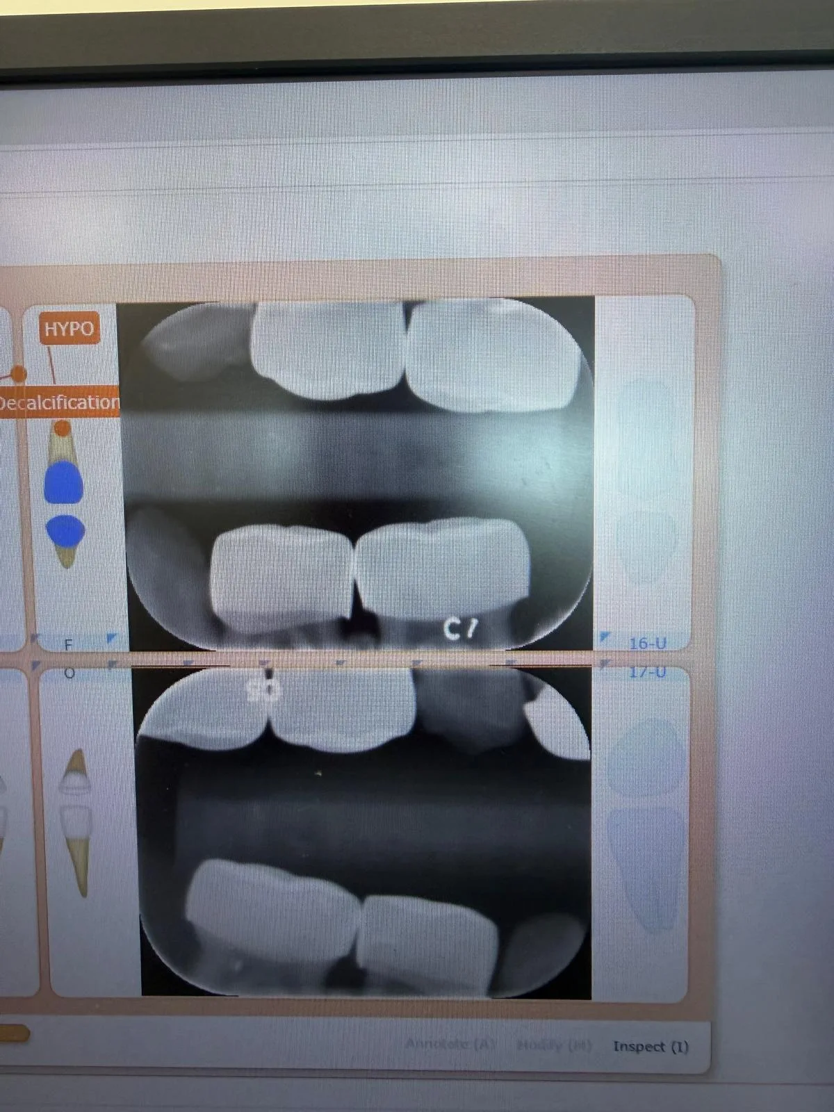 Digital bitewing and periapical dental x-rays displayed on the operatory screen